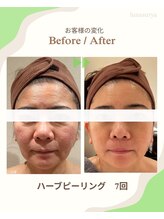 ルナスーリヤ 仙台店/ハーブピーリング