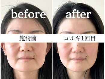 サロンドエチュール(Salon de ETULE)/【ビフォーアフター】コルギ1回