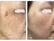 カンパニュラ(campanula)の雰囲気（「隠す肌」から「魅せる肌」へ。ドクターピュールボーテ取扱店）