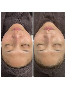 サロン エヌ(SALON N)/マイルドピーリング