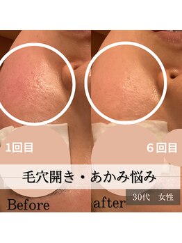 パルティノ 高崎店/毛穴開き・あかみで厚塗りメイク