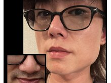 スムース イー(Smooth+E)/【メンズヒゲ脱毛】都度払い