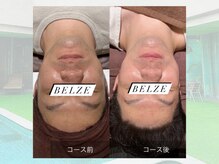 ベルゼ 渋谷店(BELZE)/ラジオ波フェイシャル