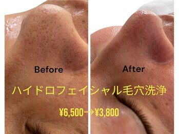 ブライトプラス(BRIGHT+)/ハイドロフェイシャル毛穴洗浄