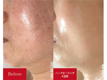 メロー(MELLOW)/ハーブピーリング(60代/ハリ)