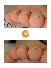 改善 根本 恵比寿院/親指以外の巻き爪症例画像