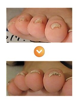 改善 根本 恵比寿院/親指以外の巻き爪症例画像