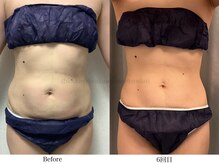 スラリ(SLARI)/【腹部　脂肪冷却】期間3ヶ月