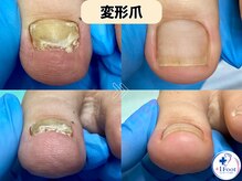 プラスワンフット 本厚木(+1 Foot)/伸びずに厚くなった足の親指の爪