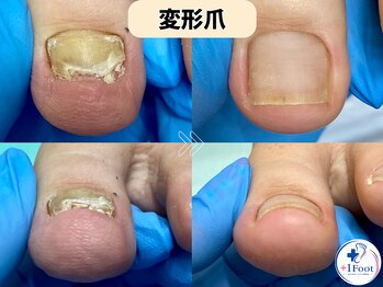 プラスワンフット 本厚木(+1 Foot)/伸びずに厚くなった足の親指の爪