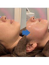 ダイヤモンドビューティー(Diamond Beauty)/ほうれい線たるみケア