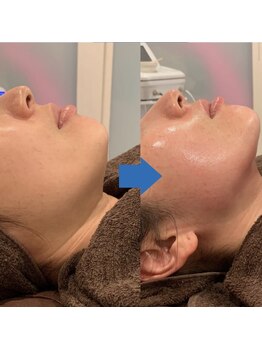 ダイヤモンドビューティー(Diamond Beauty)/ほうれい線たるみケア