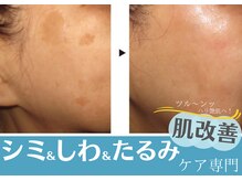 凛音の雰囲気（施術回数12回ホームケアも同時に行いシミ改善ツヤピカ肌UP！）