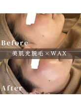 エピナ 横浜店(Epina)/フェイシャル脱毛/顔WAX脱毛