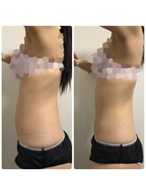 リボディ プラチナ(Rebody platinum)/ボディスカルプト（電磁パルス）