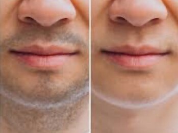 ルナ(Luna)/ヒゲWax脱毛