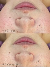 エステサロン 美飾り イオンモール木更津店/before⇒after/ララピール