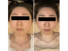 ヴェリティー(Verity)/ビフォーアフター