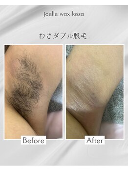 ジョエルワックス 沖縄コザ店(JOELLE WAX)/わきダブル脱毛