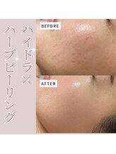 ベル(Belle)/ハイドラ×ハーブピーリング