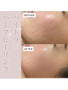 ベル(Belle)/ハイドラ×ハーブピーリング