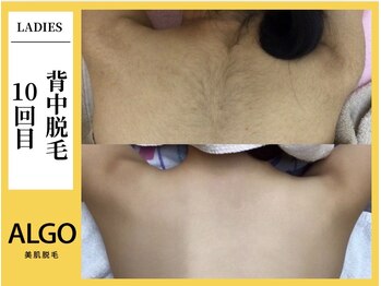 アルゴ 小倉守恒店(ALGO)/背中脱毛