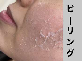 シャルムクリニカルサロン 池袋(Charme clinical salon)/肌質改善◎剥離ハーブピーリング