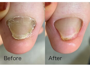 ロンディネ(Rondine)/トラブルネイル1106