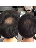 【新】最新微細針美容で頭皮環境改善＆育毛促進 ¥16980→¥5980【30分】