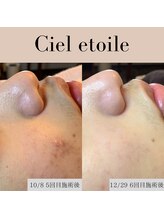 シエルエトワレ/メンズ 毛穴エクストラクション