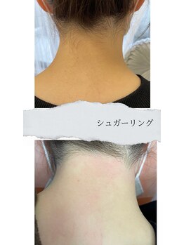 ケトリーナ/シュガーリング &nbsp;ブラジリアン