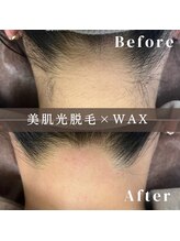 エピナ 横浜店(Epina)/うなじ脱毛/ブライダル脱毛