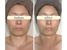 ユジュ(yju)/フェイシャル　肌質根本改良