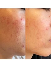 シャイネル(SHYNELL)/ハーブリプロ3回のお写真です！