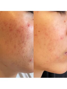 シャイネル(SHYNELL)/ハーブリプロ3回のお写真です!