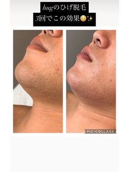 ハグ(hug)/ひげ脱毛