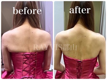 レイビス 郡山店(RAYVIS)/人気のブライダルエステ♪ 毛穴