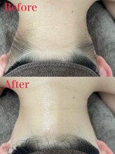ミース 越谷店/うなじ矯正●Before、After