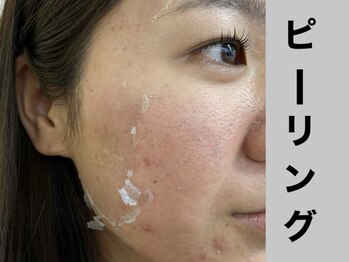 シャルムクリニカルサロン 池袋(Charme clinical salon)/肌質改善◎剥離ハーブピーリング