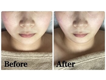 ルピア(L'pur)/お顔のビフォーアフター★