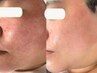 【赤ら顔】光フェイシャルで叶える均一美肌/毛穴や肌の不調にも◎