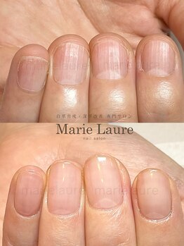 マリーロール 梅田店(Marie Laure)/深爪矯正/自爪育成/自爪風