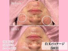 エン クリニカルラボ(E&N CLINICAL LABO)/ハーブピーリング白玉パッケージ