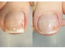 ロンディネ(Rondine)/巻き爪&フットケア&ネイルトリム