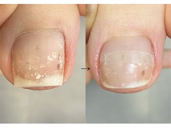 ロンディネ(Rondine)/巻き爪&フットケア&ネイルトリム