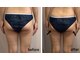 ネロリ(Neroli)の写真/【本格痩身マシン導入】夏に向けて本気の痩身エステで、気になる凸凹セルライトや脂肪を燃焼!