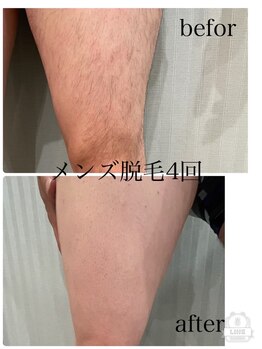 アネラ(ANELA)/メンズ脱毛