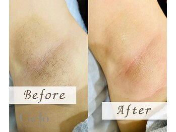 シエロ 町田店(Cielo)/『脇シュガーリング×美容脱毛』