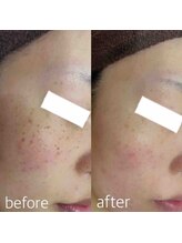 ブランシェ 野々市店 × 椿/シミケア『３０代お客様』