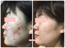 《上記の肌施術可能/敏感肌/乾燥肌》